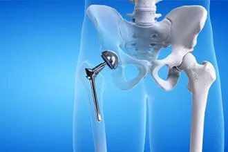 Do I need a hip replacement?